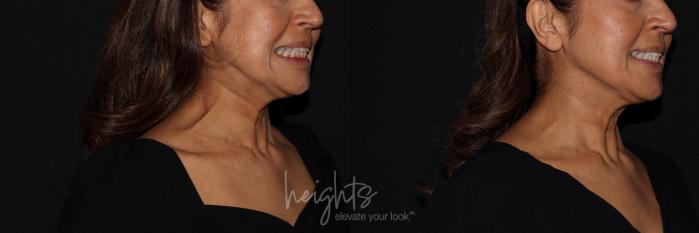 Before & After BOTOX COSMETIC® Case 137 Right Oblique View in Vancouver (Burnaby), BC
