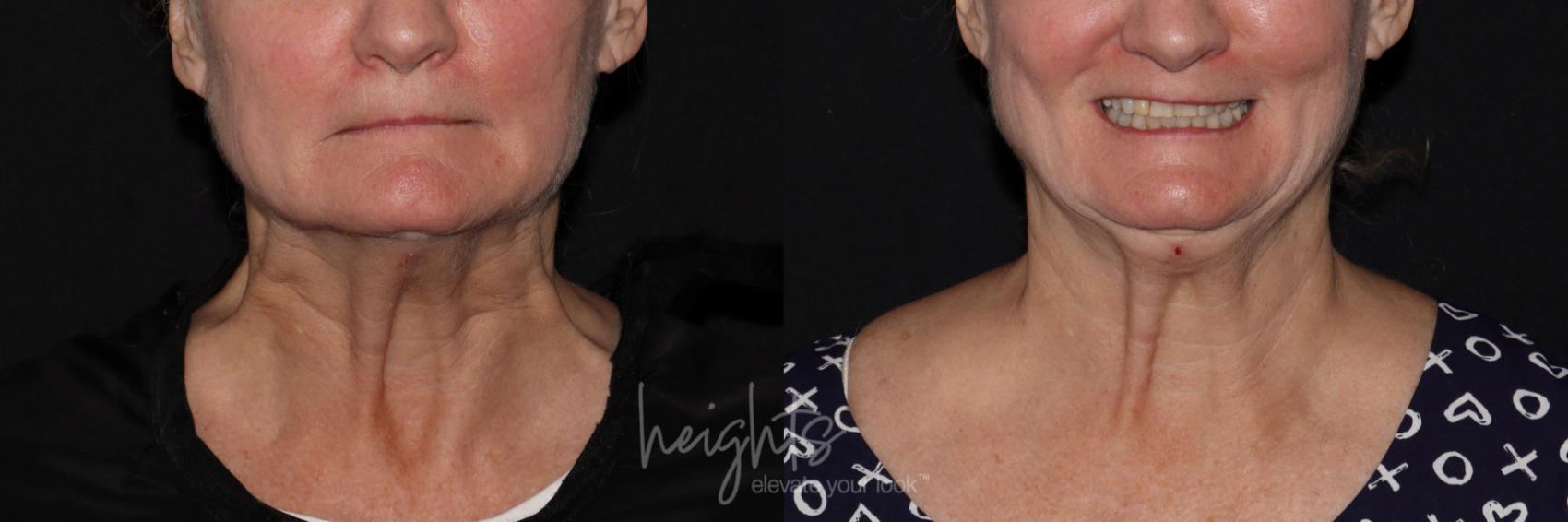 Before & After BOTOX COSMETIC® Case 138 Front View in Vancouver (Burnaby), BC