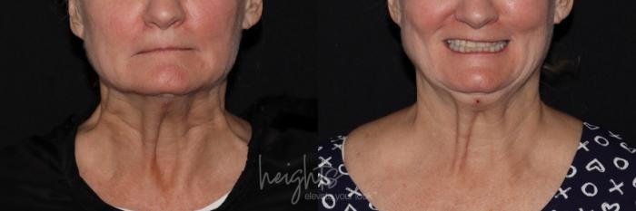 Before & After BOTOX COSMETIC® Case 138 Front View in Vancouver (Burnaby), BC