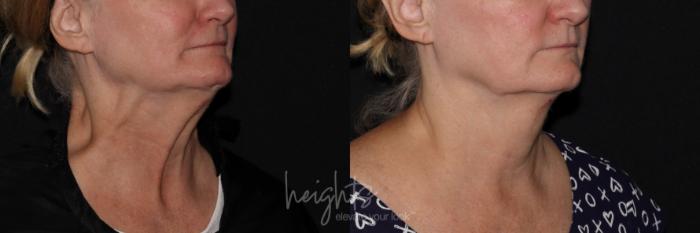 Before & After BOTOX COSMETIC® Case 138 Right Side View in Vancouver (Burnaby), BC