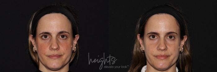 Before & After BOTOX COSMETIC® Case 140 Front View in Vancouver (Burnaby), BC