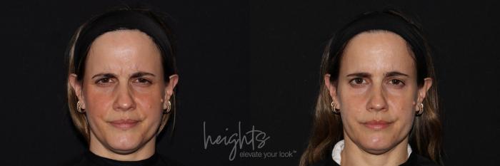 Before & After BOTOX COSMETIC® Case 140 Frontal frown View in Vancouver (Burnaby), BC