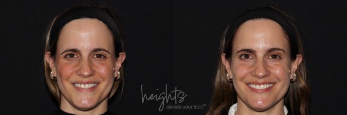 Before & After BOTOX COSMETIC® Case 140 frontal smile View in Vancouver (Burnaby), BC