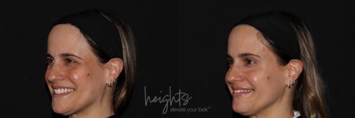 Before & After BOTOX COSMETIC® Case 140 left oblique crows feet View in Vancouver (Burnaby), BC
