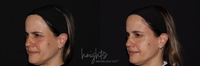 Before & After BOTOX COSMETIC® Case 140 Left Oblique View in Vancouver (Burnaby), BC