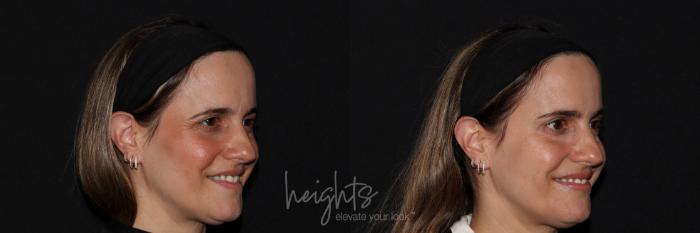 Before & After BOTOX COSMETIC® Case 140 right oblique crows feet View in Vancouver (Burnaby), BC