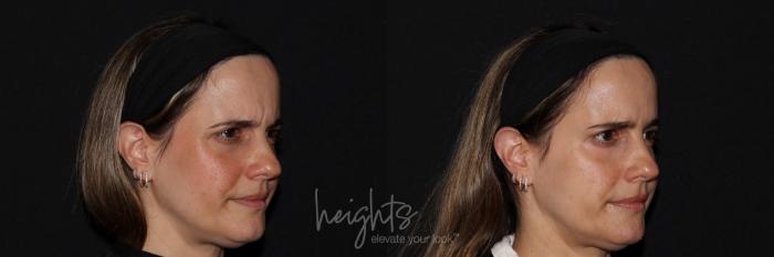 Before & After BOTOX COSMETIC® Case 140 right oblique frown View in Vancouver (Burnaby), BC