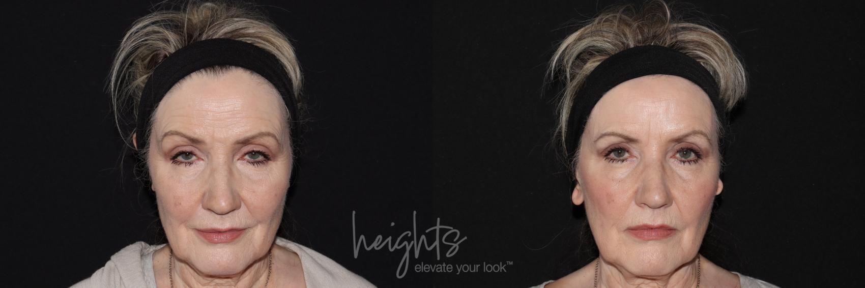 Before & After BOTOX COSMETIC® Case 146 Front View in Vancouver (Burnaby), BC