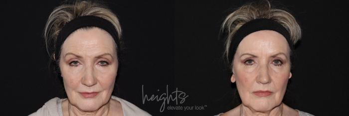Before & After BOTOX COSMETIC® Case 146 Front View in Vancouver (Burnaby), BC