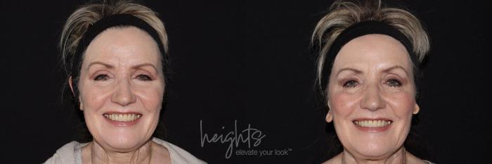 Before & After BOTOX COSMETIC® Case 146 frontal crows feet View in Vancouver (Burnaby), BC