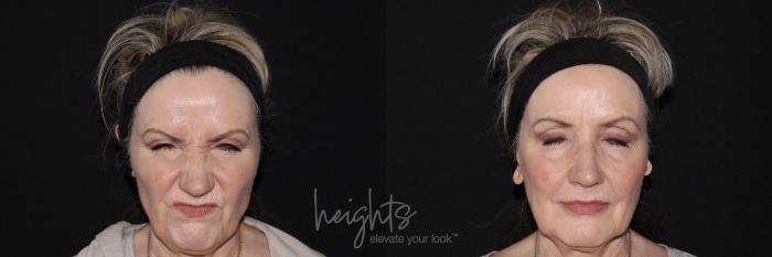 Before & After BOTOX COSMETIC® Case 146 Frontal frown View in Vancouver (Burnaby), BC