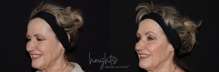 Before & After BOTOX COSMETIC® Case 146 left oblique crows feet View in Vancouver (Burnaby), BC