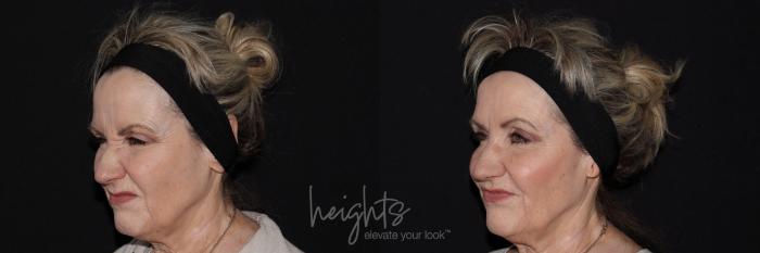 Before & After BOTOX COSMETIC® Case 146 Left Oblique View in Vancouver (Burnaby), BC