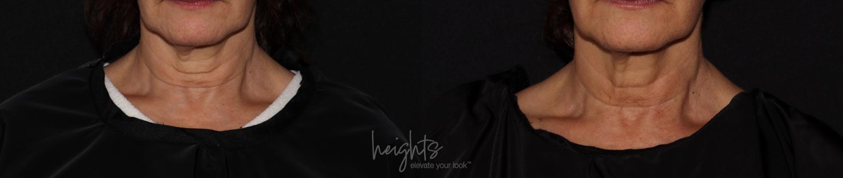 Before & After BOTOX COSMETIC® Case 149 Front at rest View in Vancouver (Burnaby), BC