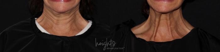 Before & After BOTOX COSMETIC® Case 149 Front on animation View in Vancouver (Burnaby), BC