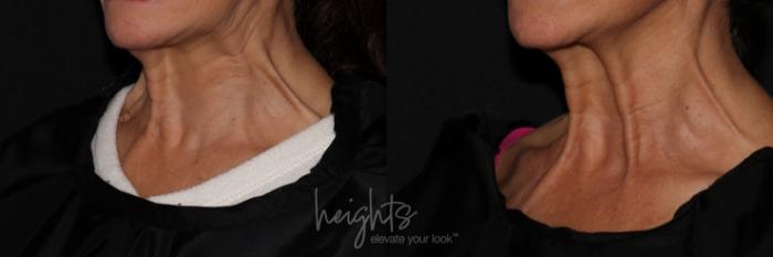 Before & After BOTOX COSMETIC® Case 149 left oblique animated  View in Vancouver (Burnaby), BC