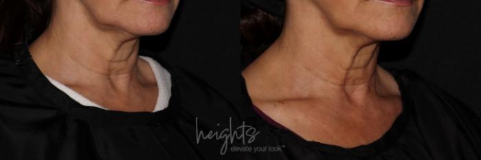 Before & After BOTOX COSMETIC® Case 149 Right Oblique View in Vancouver (Burnaby), BC
