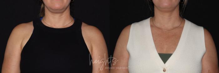 Before & After BOTOX COSMETIC® Case 151 Left Side View in Vancouver (Burnaby), BC