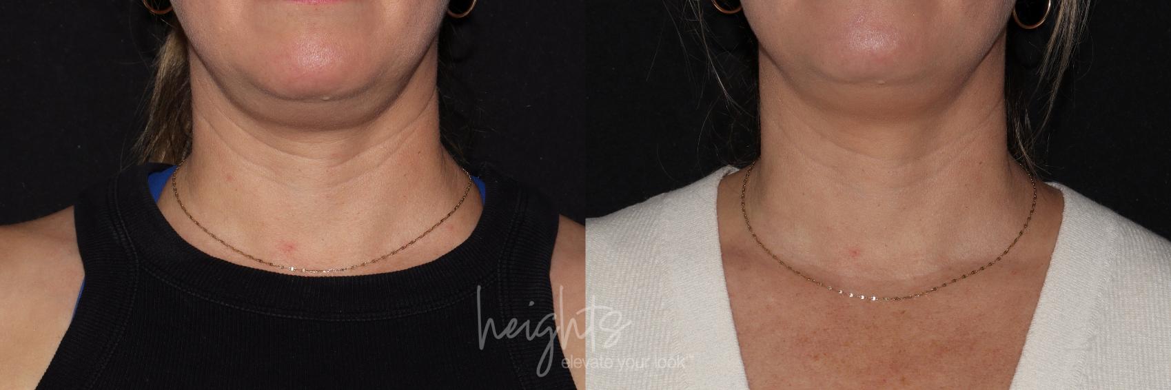 Before & After BOTOX COSMETIC® Case 152 Front View in Vancouver (Burnaby), BC