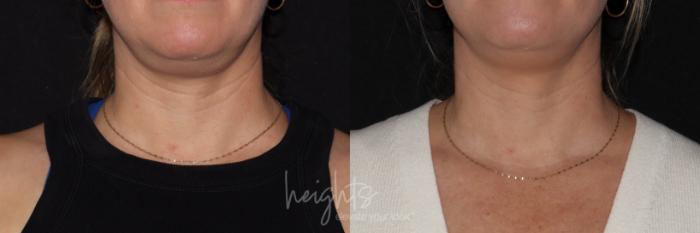 Before & After BOTOX COSMETIC® Case 152 Front View in Vancouver (Burnaby), BC