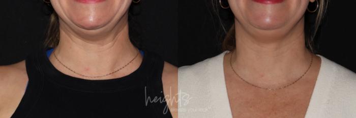 Before & After BOTOX COSMETIC® Case 152 frontal animated View in Vancouver (Burnaby), BC