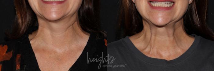 Before & After BOTOX COSMETIC® Case 153 Front View in Vancouver (Burnaby), BC