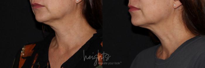 Before & After BOTOX COSMETIC® Case 153 left oblique at rest View in Vancouver (Burnaby), BC
