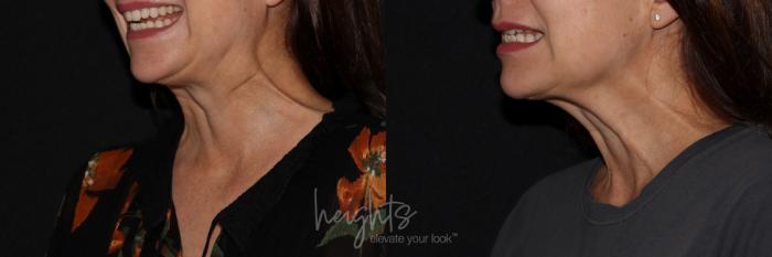 Before & After BOTOX COSMETIC® Case 153 Left Oblique View in Vancouver (Burnaby), BC