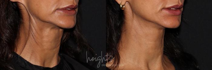 Before & After BOTOX COSMETIC® Case 154 Right Oblique View in Vancouver (Burnaby), BC