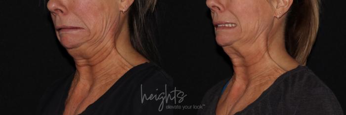 Before & After BOTOX COSMETIC® Case 155 Left oblique animated View in Vancouver (Burnaby), BC