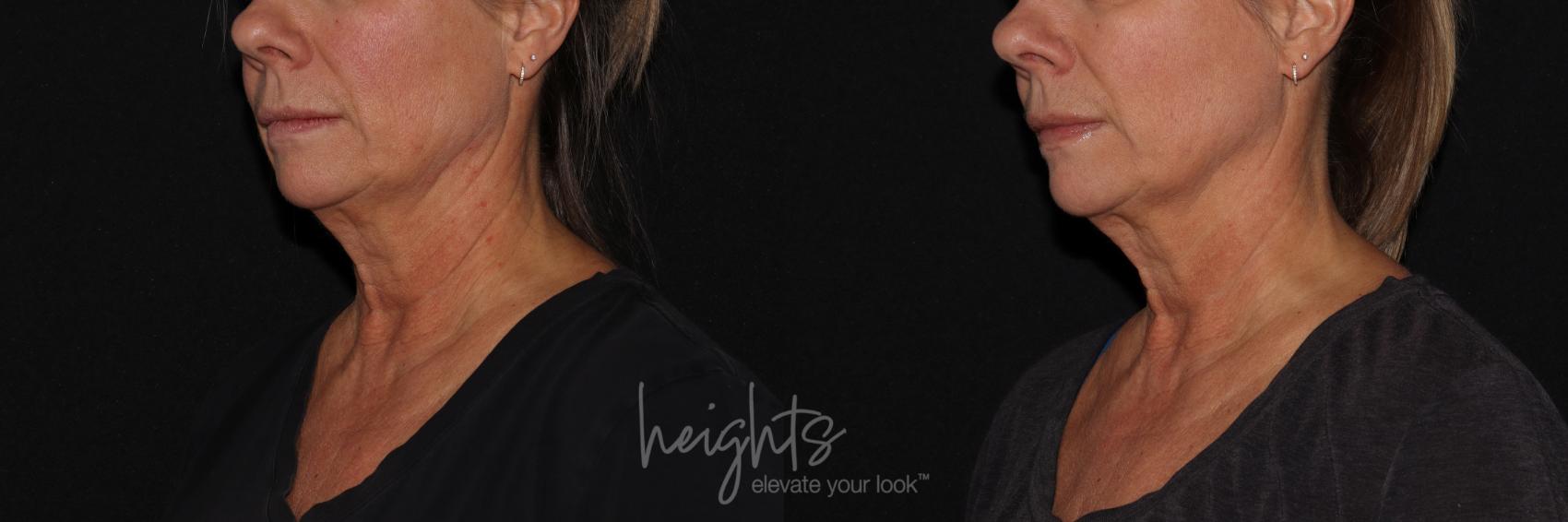 Before & After BOTOX COSMETIC® Case 155 Left Oblique View in Vancouver (Burnaby), BC