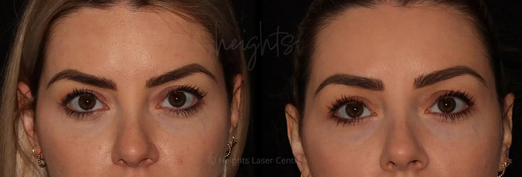 Before & After BOTOX COSMETIC® Case 50 Front View in Vancouver (Burnaby), BC