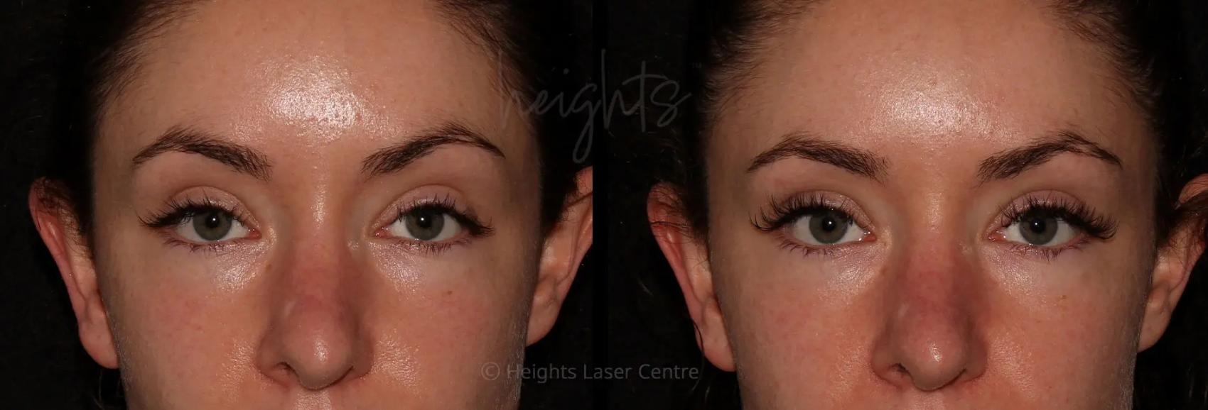Before & After BOTOX COSMETIC® Case 51 Front View in Vancouver (Burnaby), BC