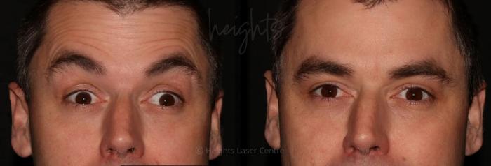 Before & After BOTOX COSMETIC® Case 55 Front - Forehead Lines View in Vancouver (Burnaby), BC