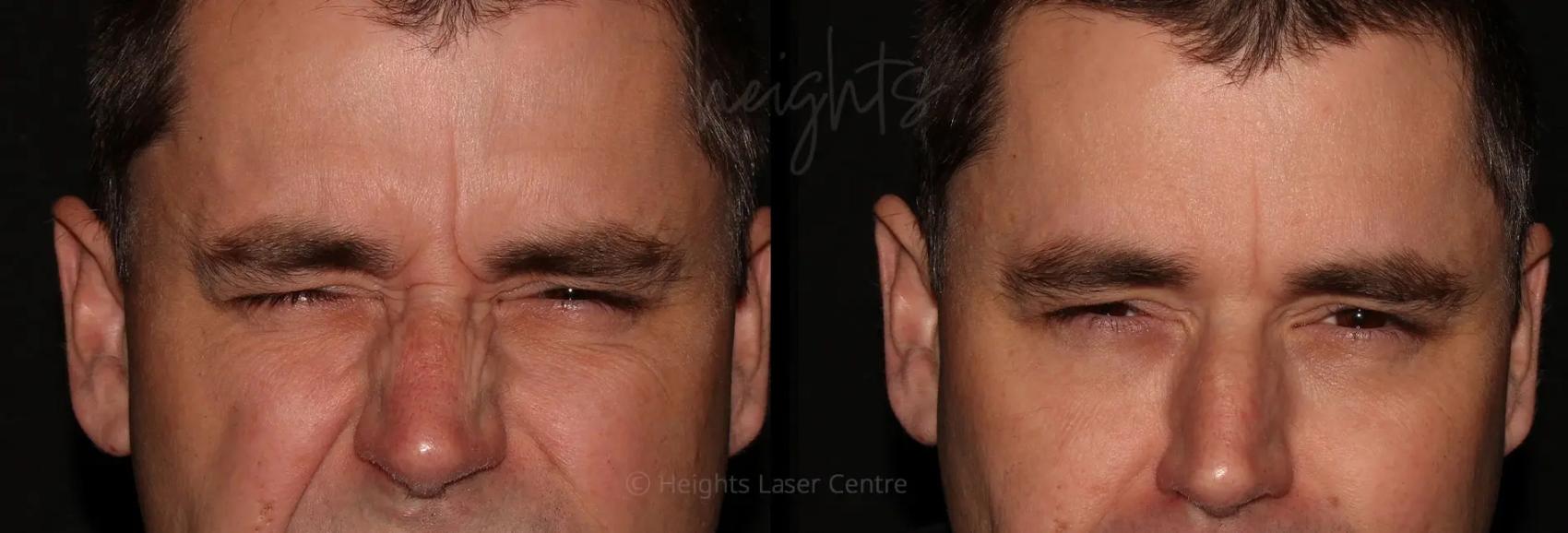 Before & After BOTOX COSMETIC® Case 55 Front - Frown Lines View in Vancouver (Burnaby), BC