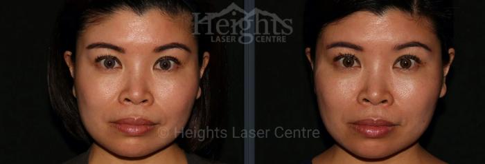Before & After BOTOX COSMETIC® Case 56 Front View in Vancouver (Burnaby), BC