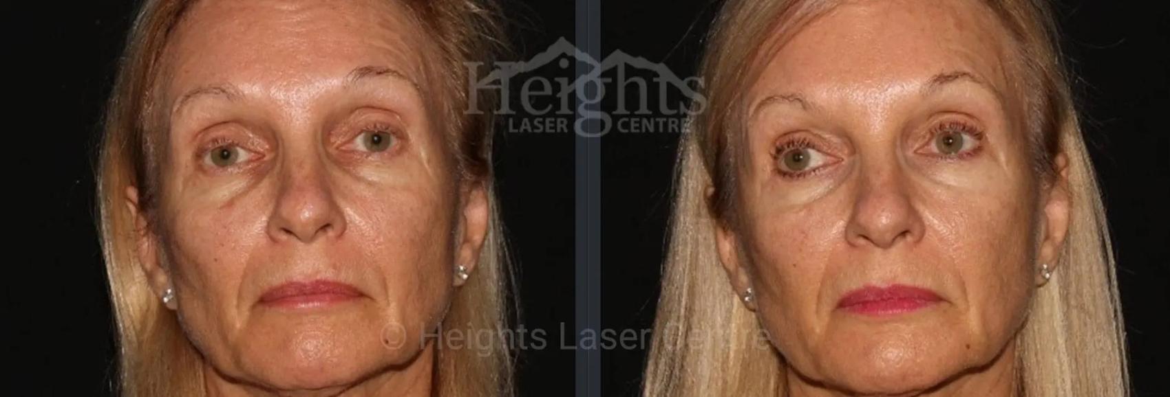 Before & After BOTOX COSMETIC® Case 57 Front View in Vancouver (Burnaby), BC