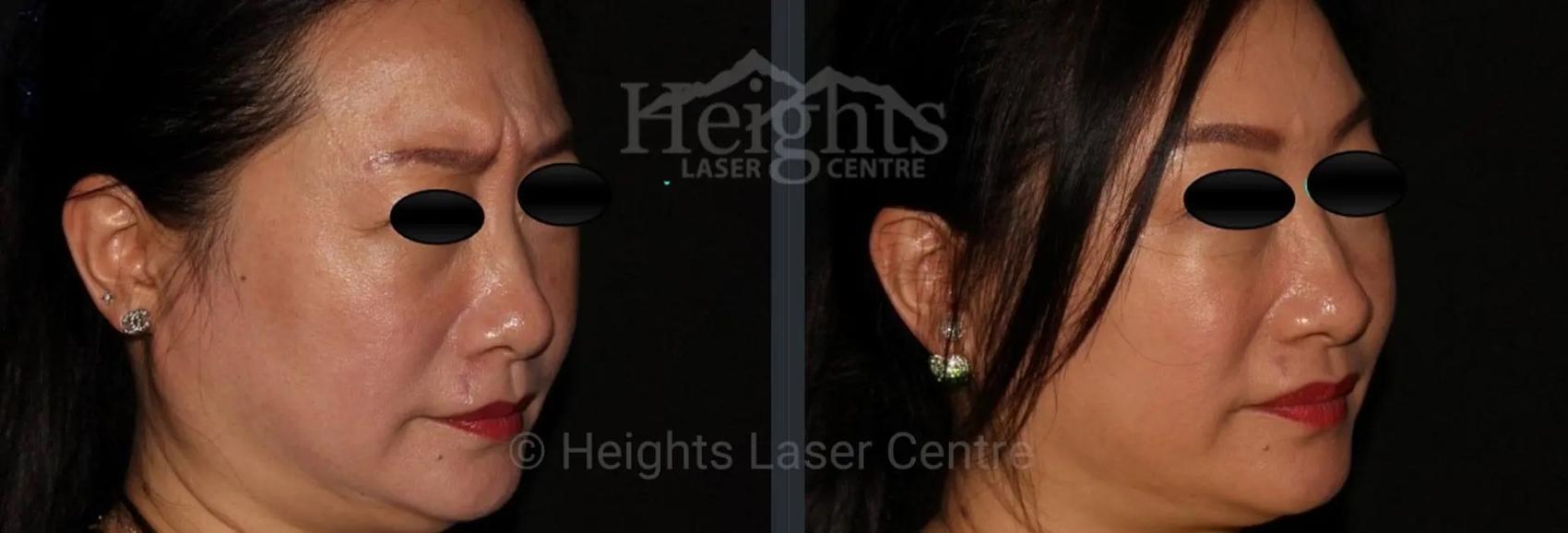 Before & After BOTOX COSMETIC® Case 59 Right Oblique View in Vancouver (Burnaby), BC