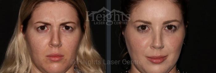 Before & After BOTOX COSMETIC® Case 60 Front View in Vancouver (Burnaby), BC