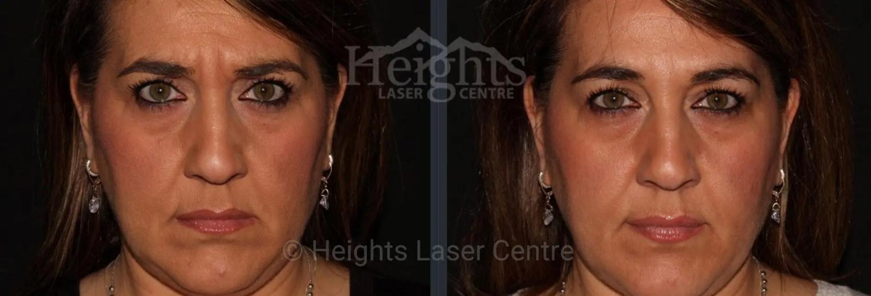 Before & After BOTOX COSMETIC® Case 61 Front View in Vancouver (Burnaby), BC