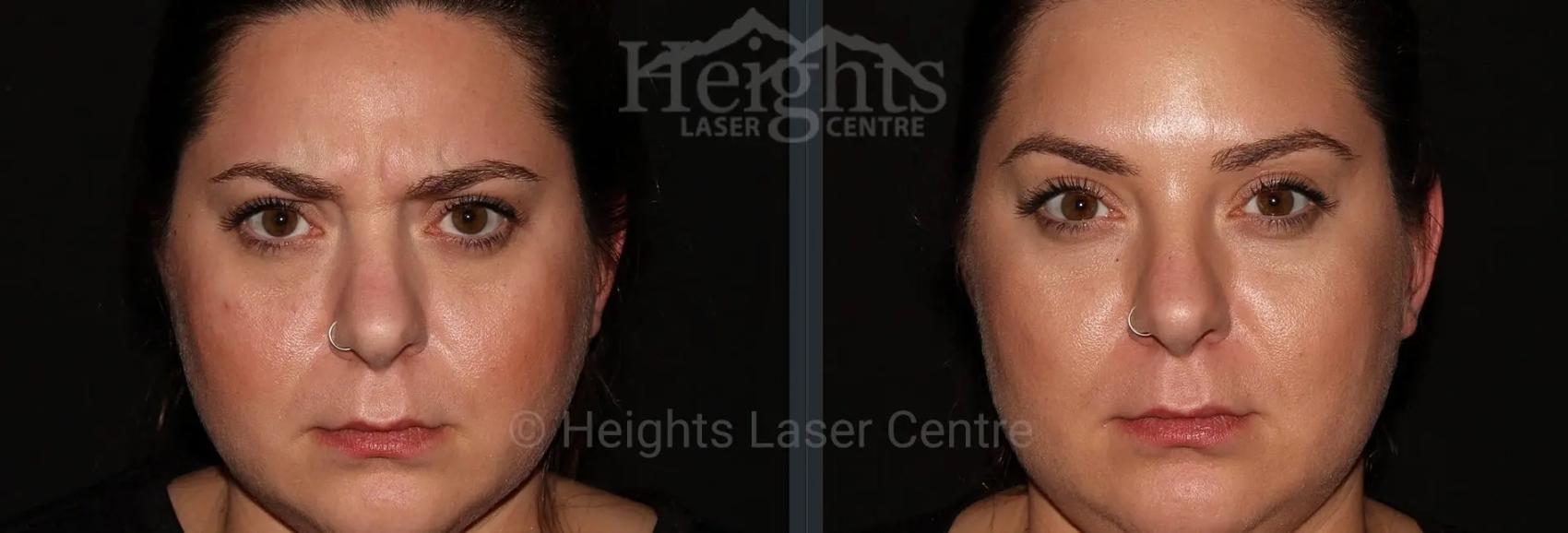Before & After BOTOX COSMETIC® Case 64 Front View in Vancouver (Burnaby), BC