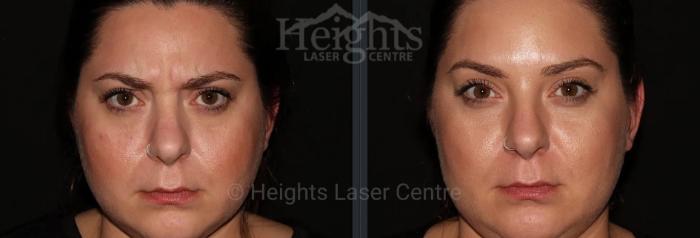 Before & After BOTOX COSMETIC® Case 64 Front View in Vancouver (Burnaby), BC