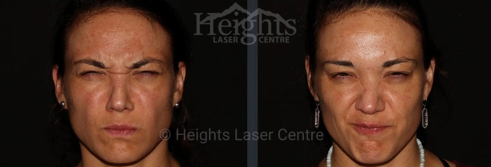 Before & After BOTOX COSMETIC® Case 65 Front View in Vancouver (Burnaby), BC