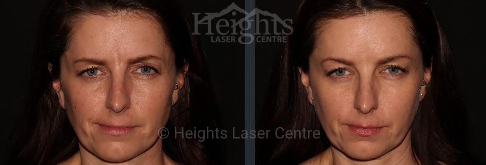 Before & After BOTOX COSMETIC® Case 66 Front View in Vancouver (Burnaby), BC