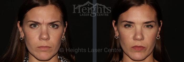 Before & After BOTOX COSMETIC® Case 67 Front View in Vancouver (Burnaby), BC