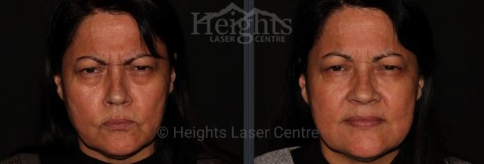 Before & After BOTOX COSMETIC® Case 68 Front View in Vancouver (Burnaby), BC