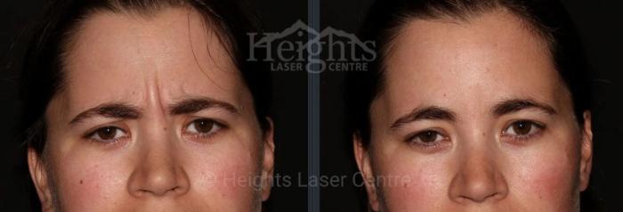 Before & After BOTOX COSMETIC® Case 69 Front View in Vancouver (Burnaby), BC