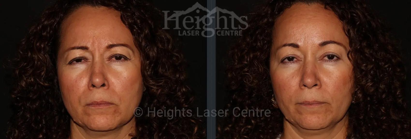 Before & After BOTOX COSMETIC® Case 70 Front View in Vancouver (Burnaby), BC