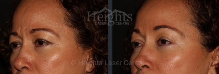 Before & After BOTOX COSMETIC® Case 70 Left Oblique View in Vancouver (Burnaby), BC