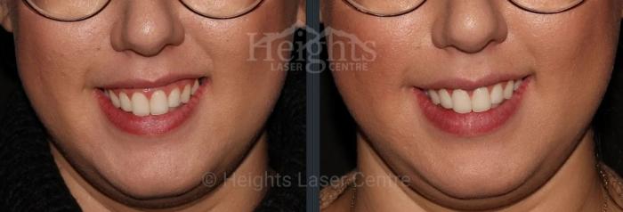 Before & After BOTOX COSMETIC® Case 71 Front View in Vancouver (Burnaby), BC